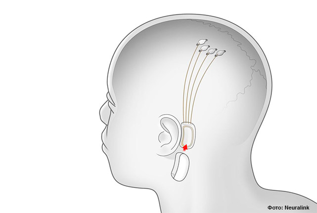 Передатчик мозговой активности будет крепиться за ухом, он же обеспечит бесконтактное электропитание и связь с датчиками