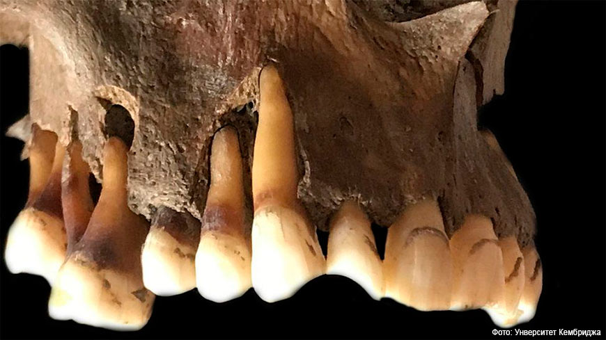 Один из образцов ДНК герпеса был взят из зубов датчанина 17-го века